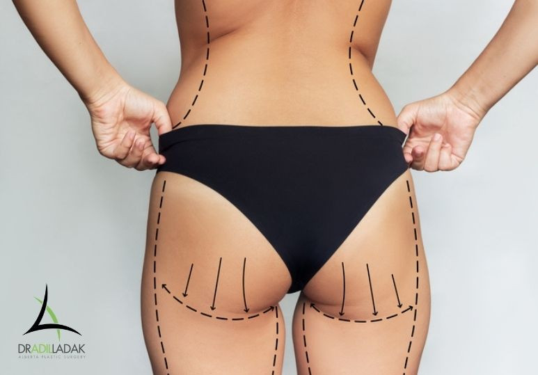 Recovery After Body Contouring Surgery: Tips for a Smooth Healing Process 